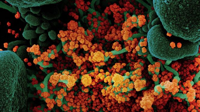 Imagen coloreada tomada por un microscopio electrónico de una célula en apoptosis (verde) gravemente infectada por el virus  SARS-COV-2 (naranja).