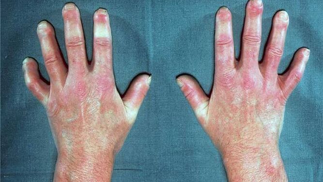Qué es la esclerodermia, la enfermedad incurable de la piel dura