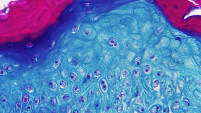 Imagen ampliada con un microscopio de una muestra de piel de un mono  infectado con el virus de la viruela  del mono.