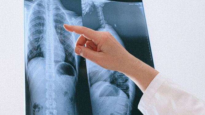 Imagen de una radiografía de un pulmón.
