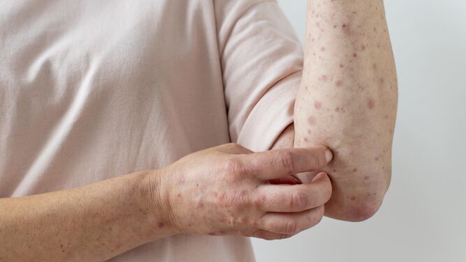 Día Mundial Dermatitis Atópica: 5 remedios naturales que alivian sus síntomas